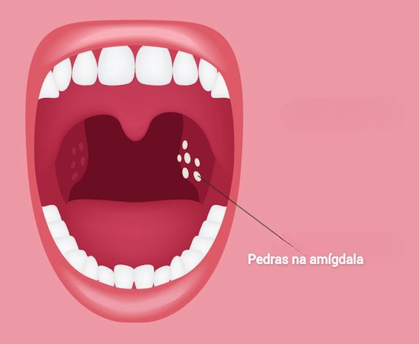 Pedras na amígdala, como tratar